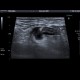 Acute diverticulitis, peridiverticulitis, sigmoid colon: US - Ultrasound
